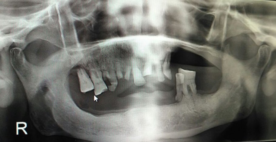 OPG for dental implants