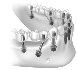 basal-implants-India