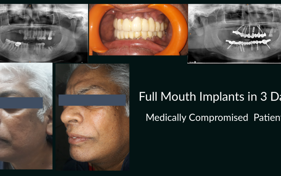 Get Fixed Implant Teeth without Bone Grafting or Sinus Lift Surgery in Just 3 Days with Advanced Basal Implants from Experts