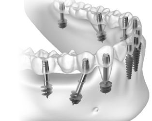 Frequently Asked Questions About Basal Implants, Including Benefits, Procedure, Cost and Maintenance.