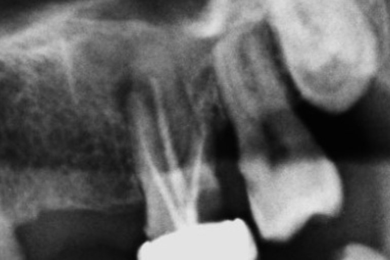 Root Canal Failure