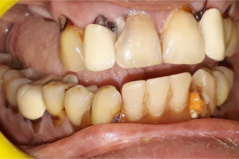 worn-off-dental-bridges