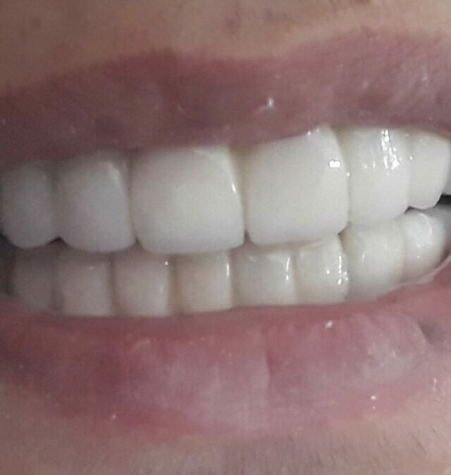 Full Mouth Implants in Just 3 Days