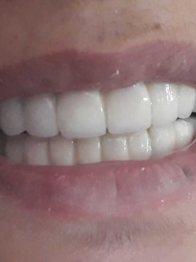 Full Mouth Implants in Just 3 Days