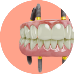 full mouth dental implants