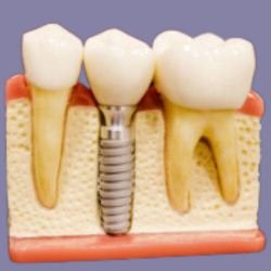 Dental Implants in Gurgaon – Dr. Prashant Implants for All Fixed Teeth Solutions