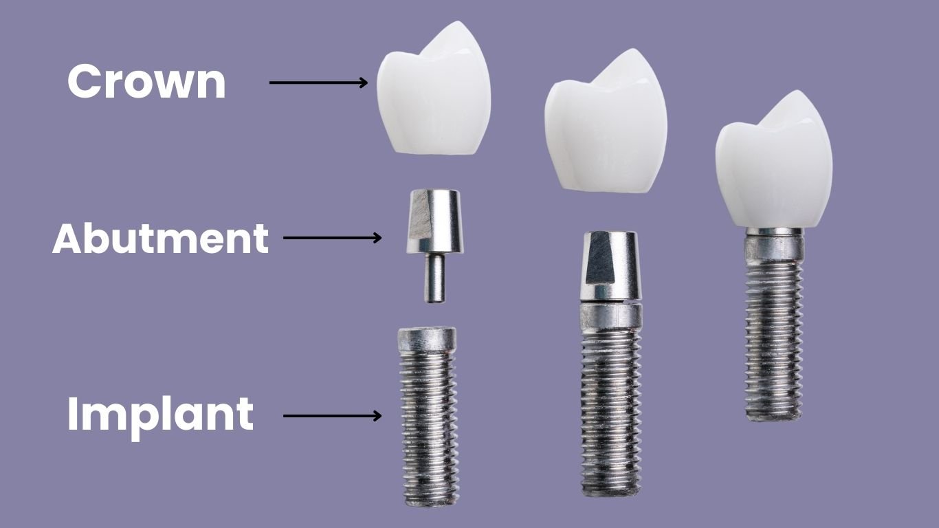 implant parts