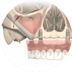 zygomatic implants