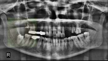 basal implant