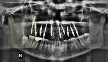 full-mouth-implants-basal