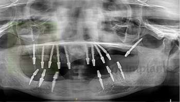 full-mouth-implants-basal