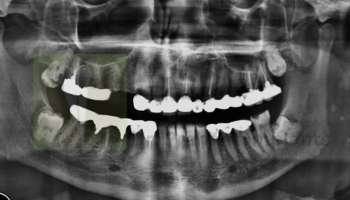 basal implant