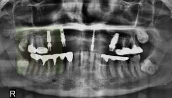 full-mouth-implants-basal