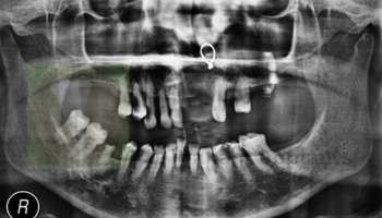 basal implant