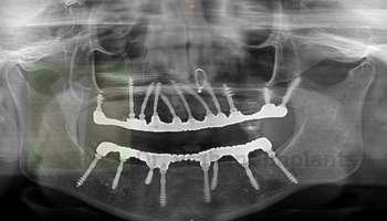 full-mouth-implants-basal